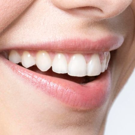 Blanqueamiento Blanqueamiento dental