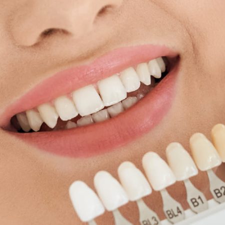 Carillas Carillas dentales