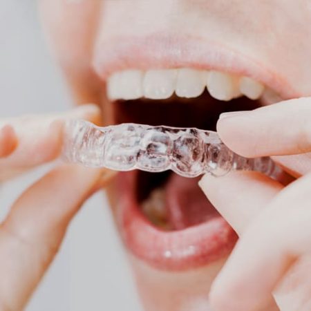 Ortodoncia invisalign