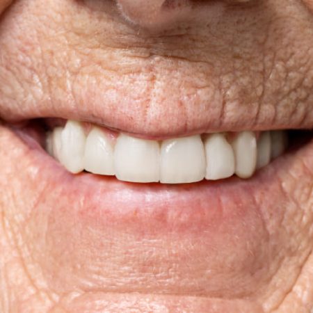 Protesis fija Protesis Fijas