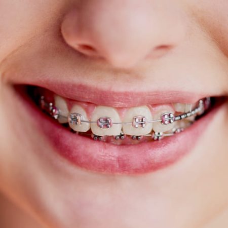 Ortodoncia metalica